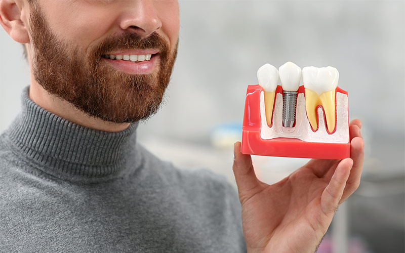 modello di impianto dentale