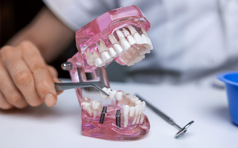 modello di implantologia dentale