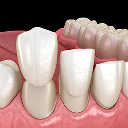 Dental veneer placement procedure. Dental 3D illustration