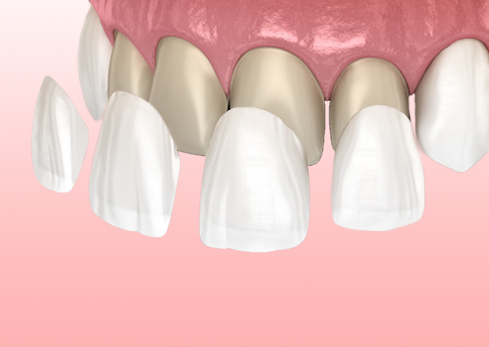 newdental-faccette-dentali-01