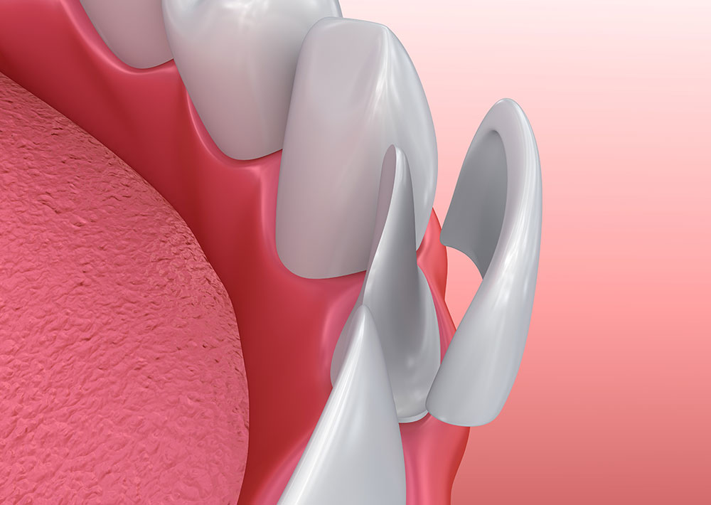 newdental-faccette-dentali