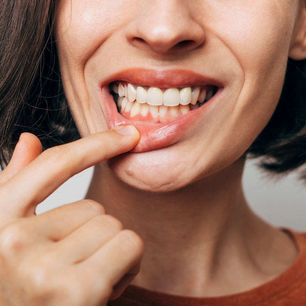 Close up shot of gum inflammation. Cropped shot of a young woman
